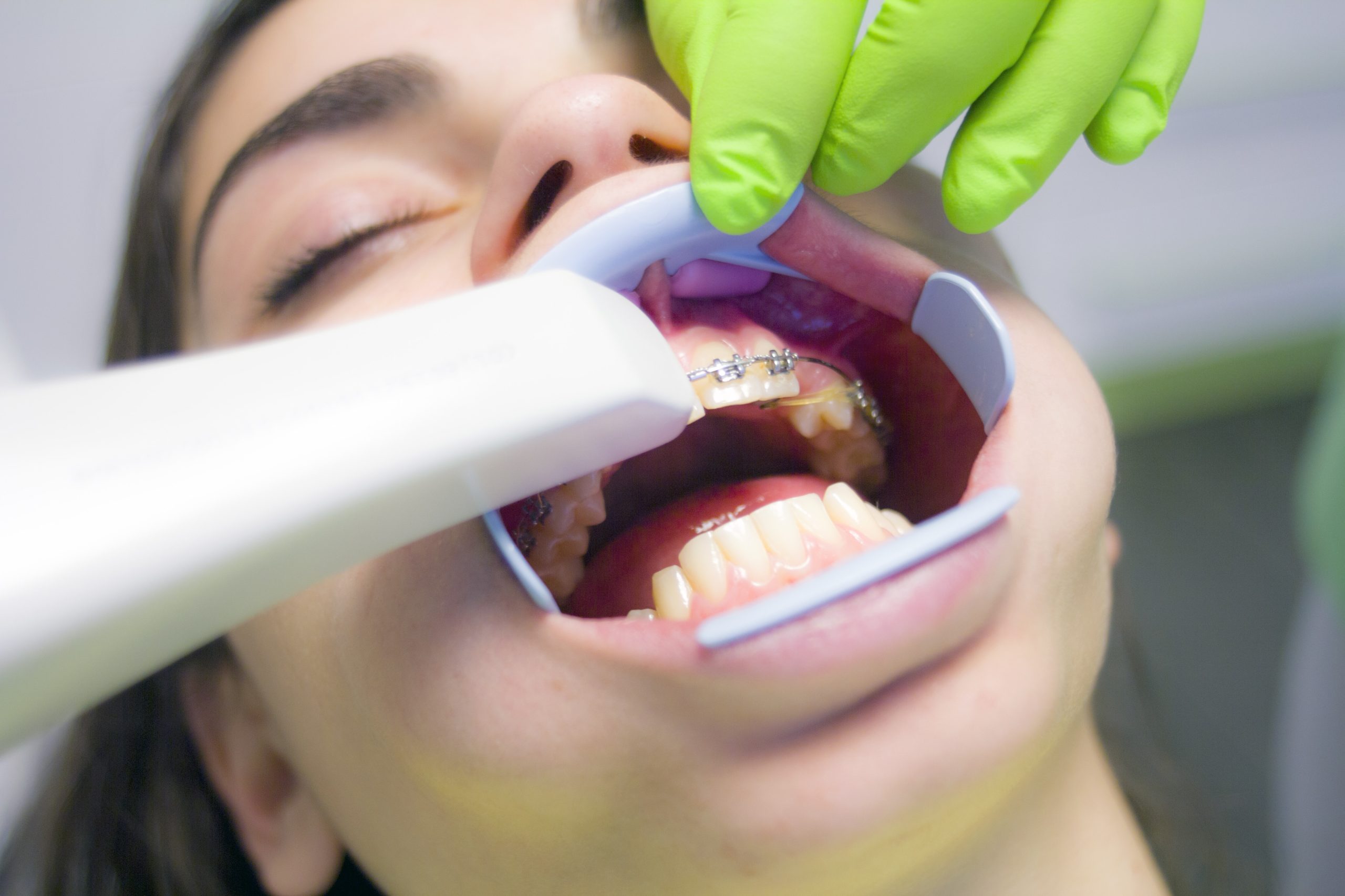3D scanning zubov